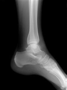 ankle-x-ray-983698-m.jpg