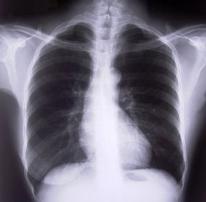 chest-xray1-262068-m.jpg