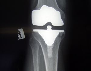knee-replacement---front-view-1183623-m.jpg